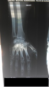 An X-ray of JTA's hand